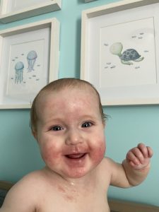 baby with eczema smiling