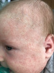 eczema on baby face