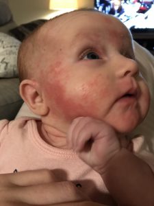 eczema on baby's cheeks